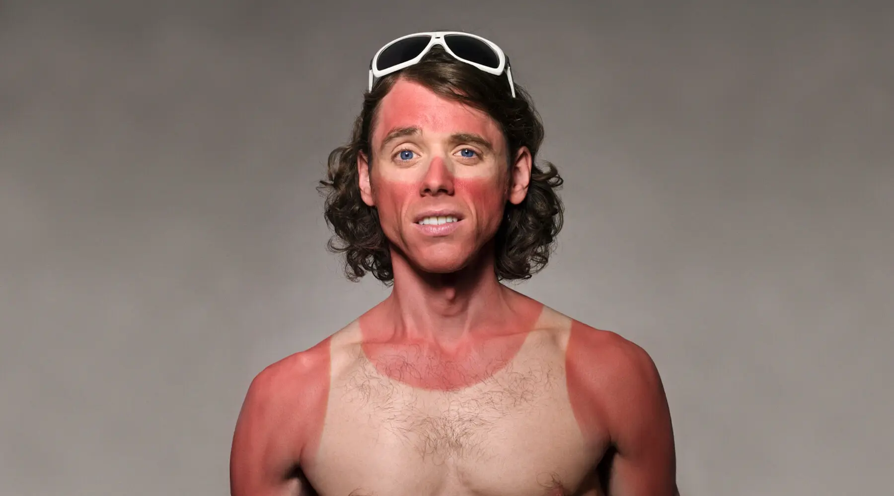 A man with sunburn